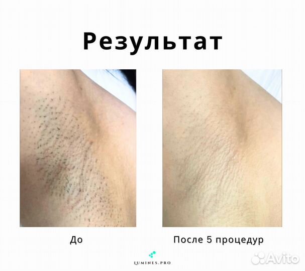 Аппарат для эпиляции Лю’минес Max’One 1200