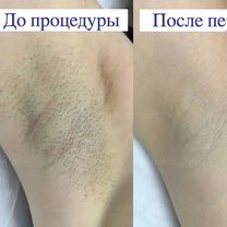 Лазерная эпиляция на Ломоносовской ЖК Стрижи, Санкт-Петербург