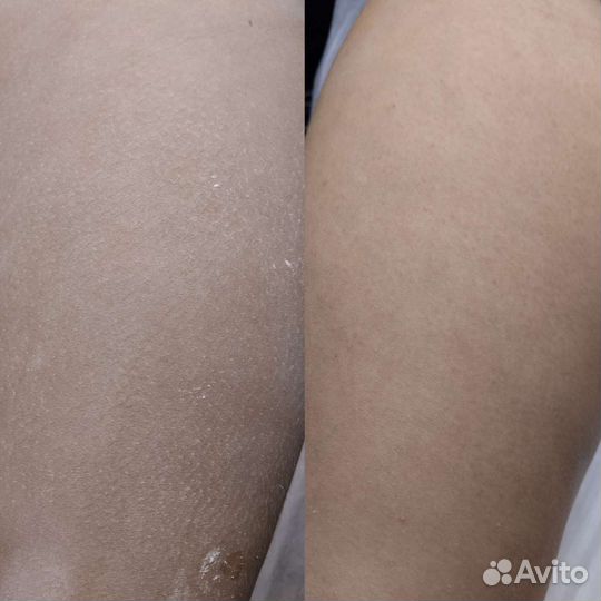 Депиляция воском: бёдра