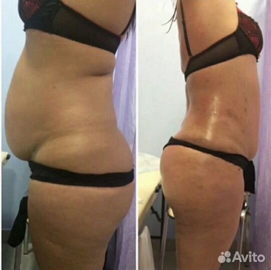 Вакуумный массаж,RF лифтинг,уз кавитаци