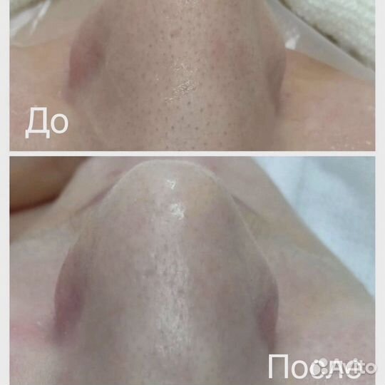 Чистка лица, пилинги