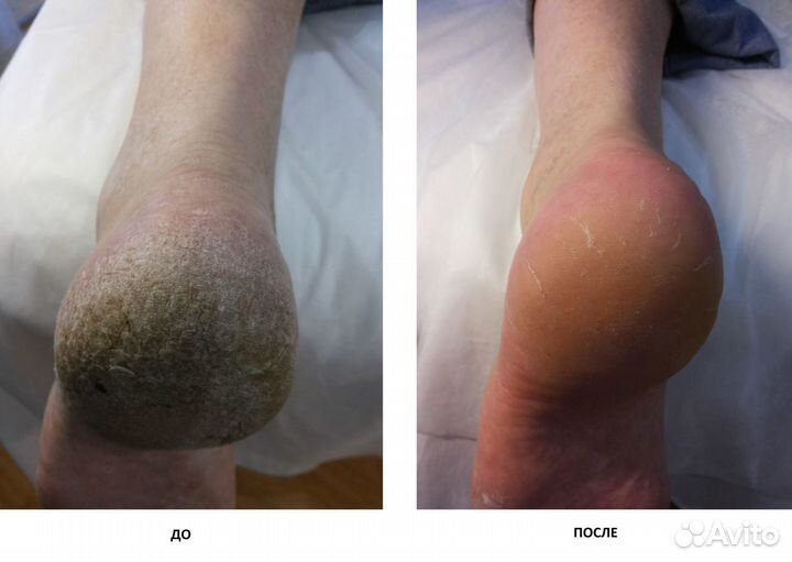 Медицинский маникюр педикюр Восстановление ногтей