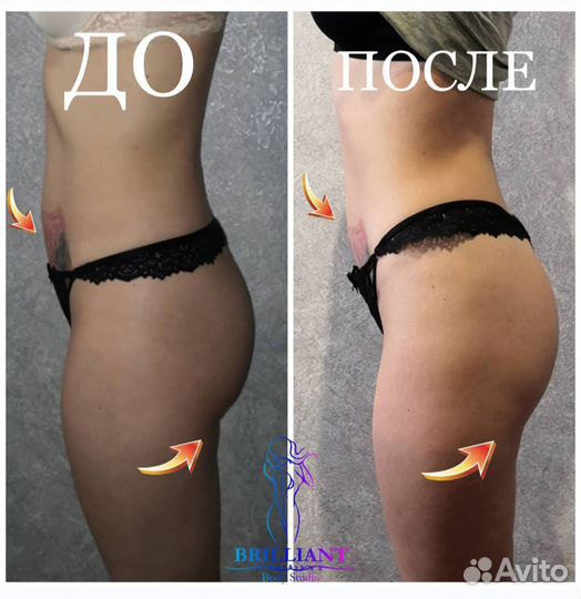 Вакуумный массаж, Кавитация, RF лифтинг