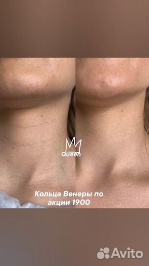 Косметолог. Губы. Ботокс