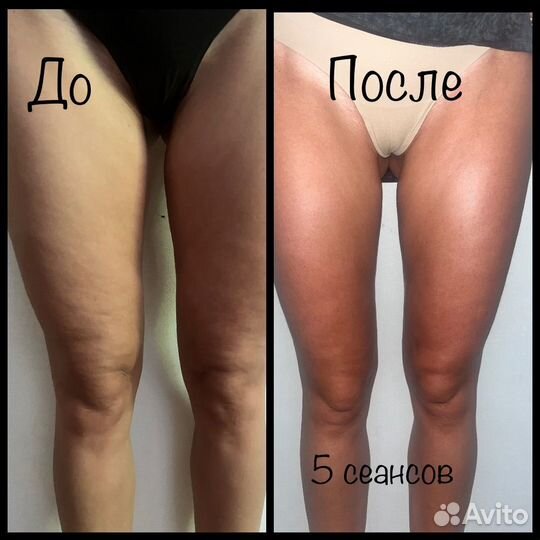 Массаж лимфодренажный, классический, антицеллюлит