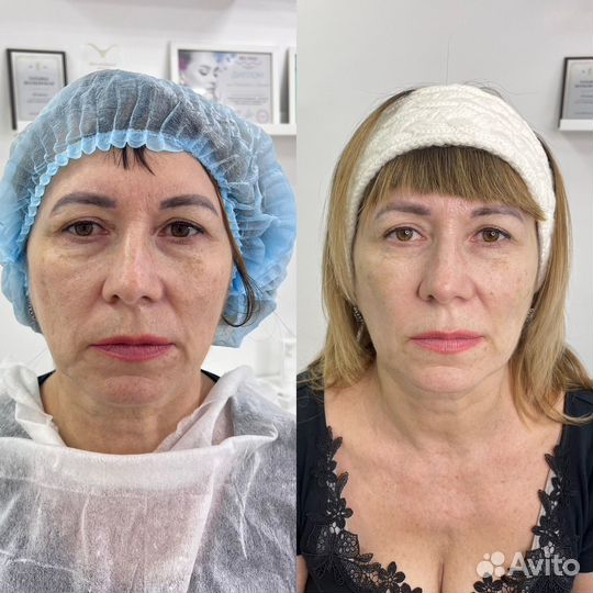 Подтяжка лица нитями