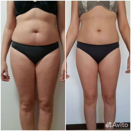 Криолиполиз, похудение