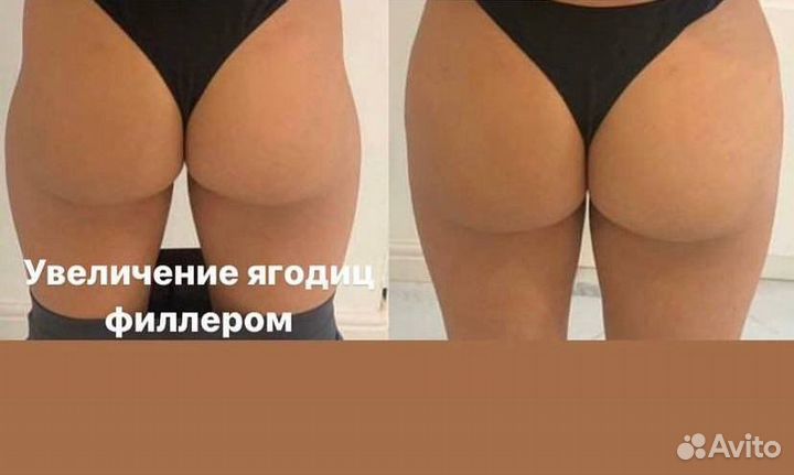 Увеличение ягодиц