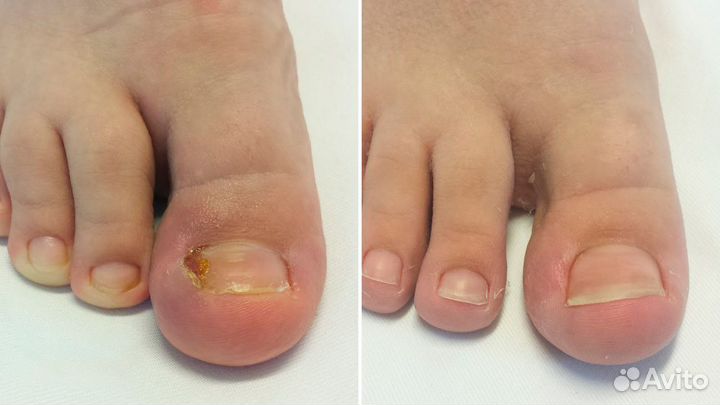 Парамедицинский педикюр - Подолог