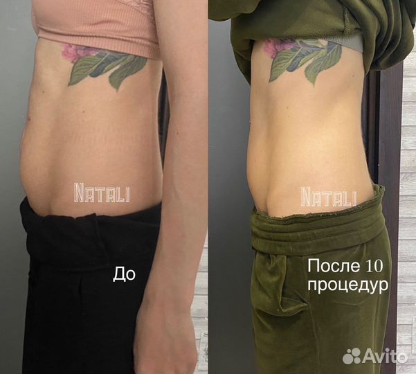 Антицеллюлитный Массаж: ручной и аппаратный