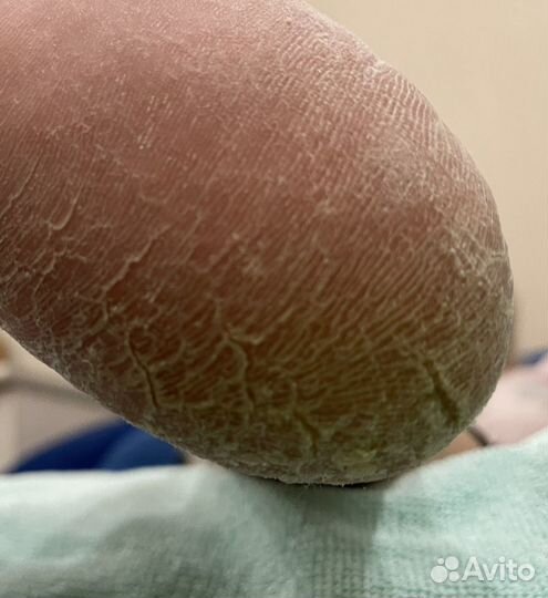 Аппаратный педикюр