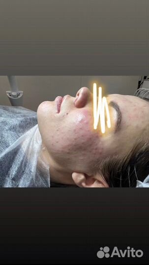 Плазмолифтинг