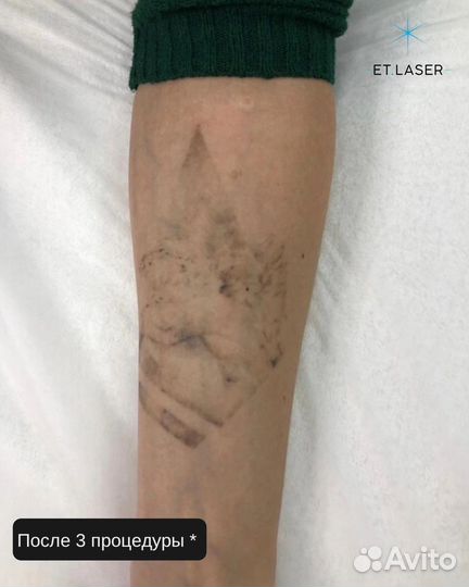 Лазерное удаление татуировок