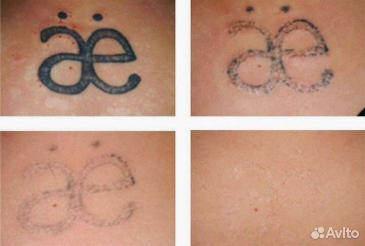 Лазерное удаление тату