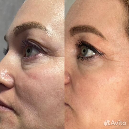 РФ лифтинг Чистка Омоложение подтяжка лица