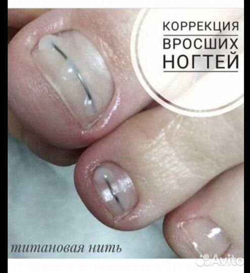 Вросший ноготь