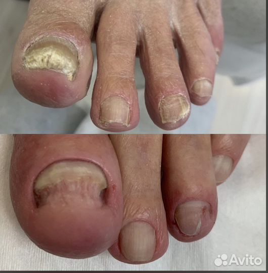 Лазерное лечение грибка ногтей и кожи