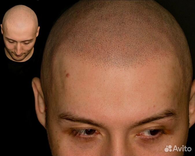 Тату волос SMP трихопигментация