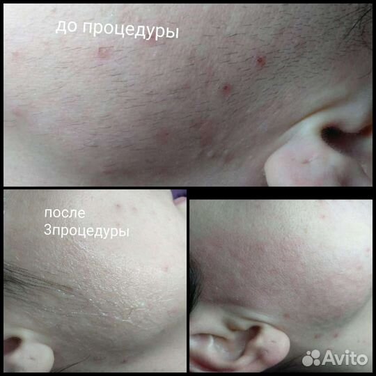 Комбинированная чистка лица