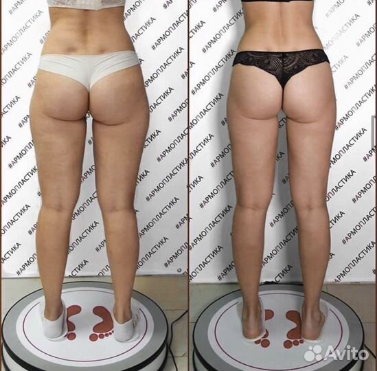 Армопластика