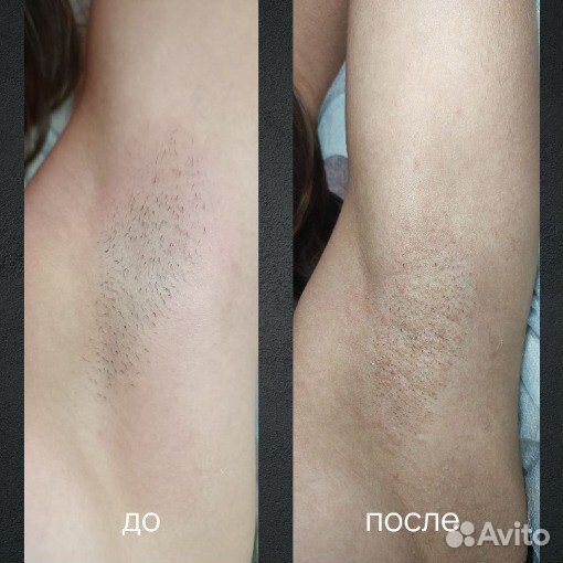 Электроэпиляция