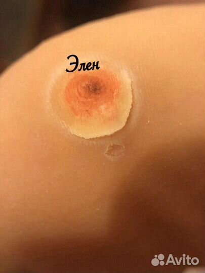 Пластырь от бородавок