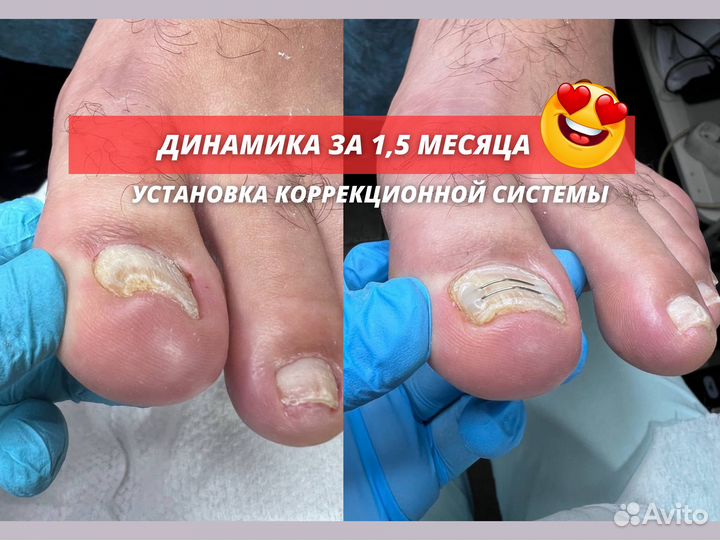 Подолог Лечение грибка Удаление мозолей