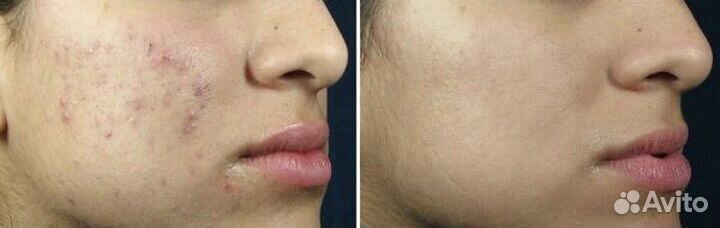 Карбоновый пилинг