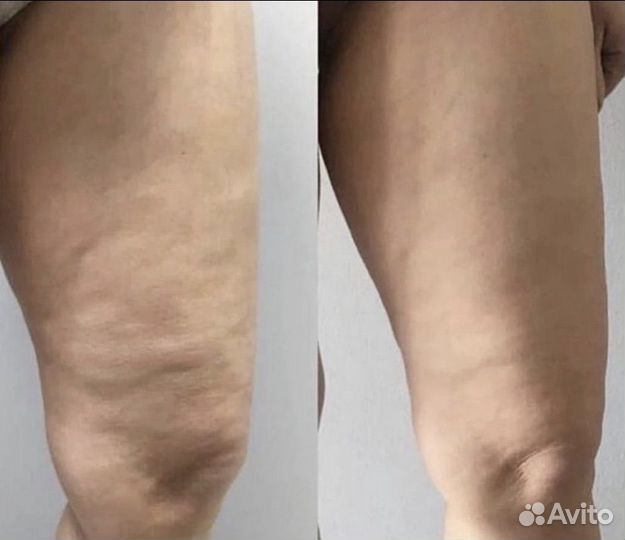 Массаж. LPG массаж.Выезд на дом