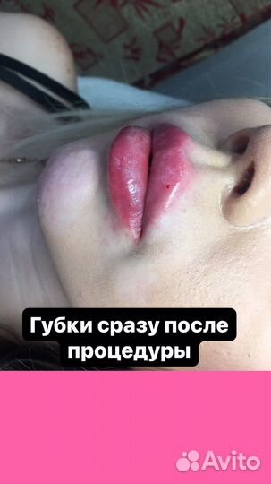 Контурная пластика губ