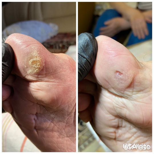 Удаление стержневых мозолей, подолог