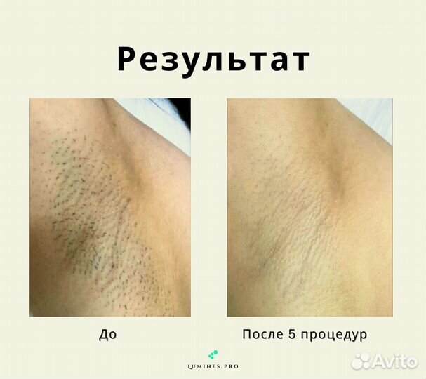 Диодный лазер Lumines Макс’Ван 1200W