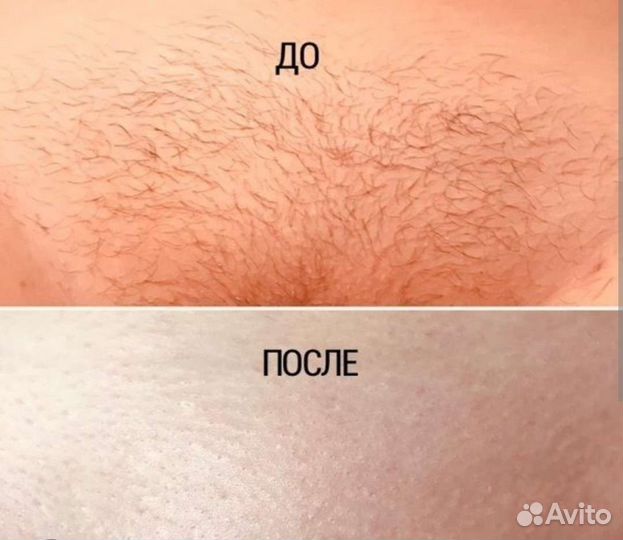 Шугаринг: подмышки