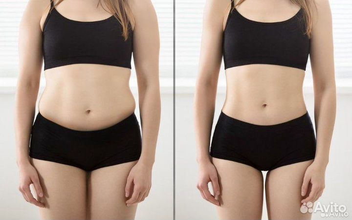 Криолиполиз, похудение