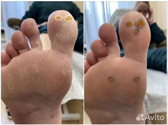 Удаление стержневых мозолей, подолог