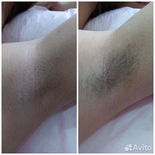 Шугаринг/ваксинг