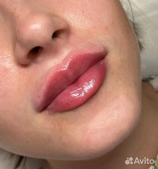 Биоревитализация