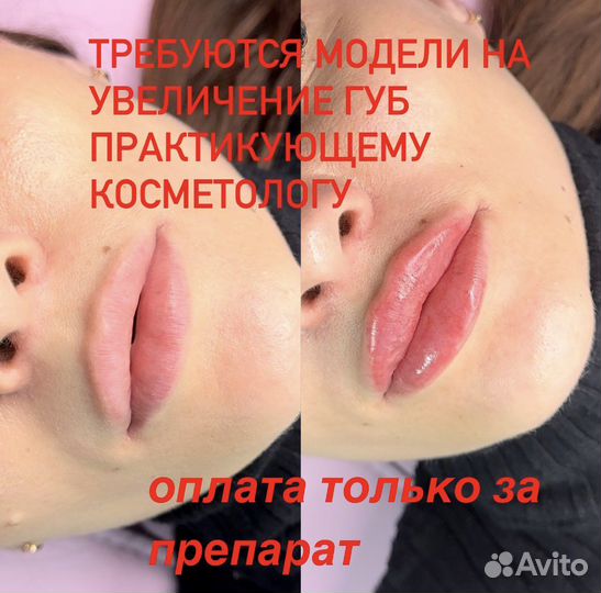 Контурная пластика губ и носогубных складок