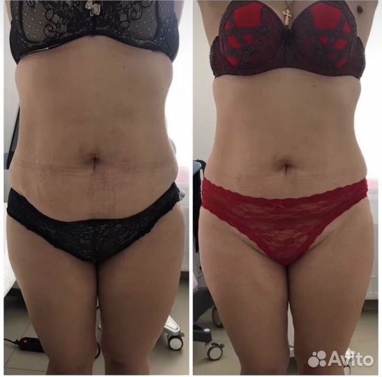 Коррекция фигуры (сфератерапия,EMC, криолиполиз)