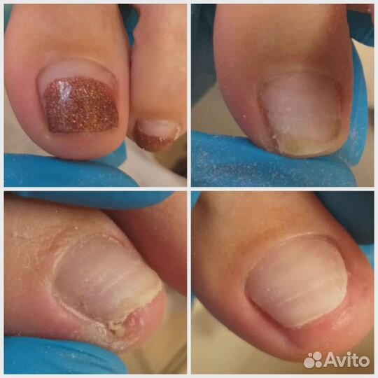 Педикюр / Подолог / Медицинский педикюр