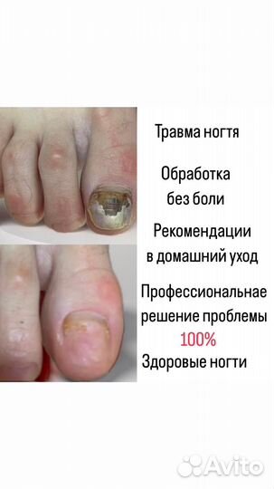 Медицинский педикюр подолог