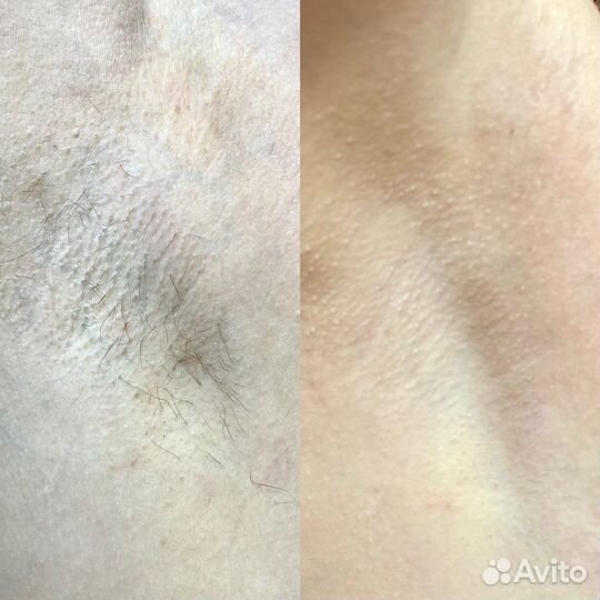 Шугаринг/Ваксинг