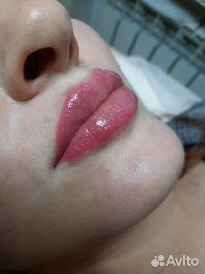 Контурная пластика губ