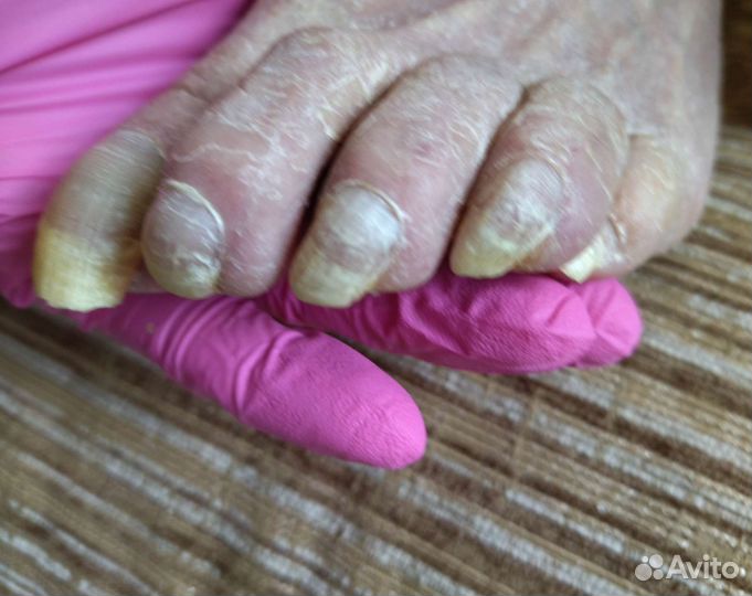 Аппаратный педикюр, выезд на дом, подолог