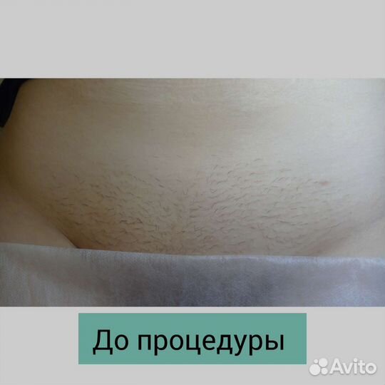 Мастер электроэпиляции