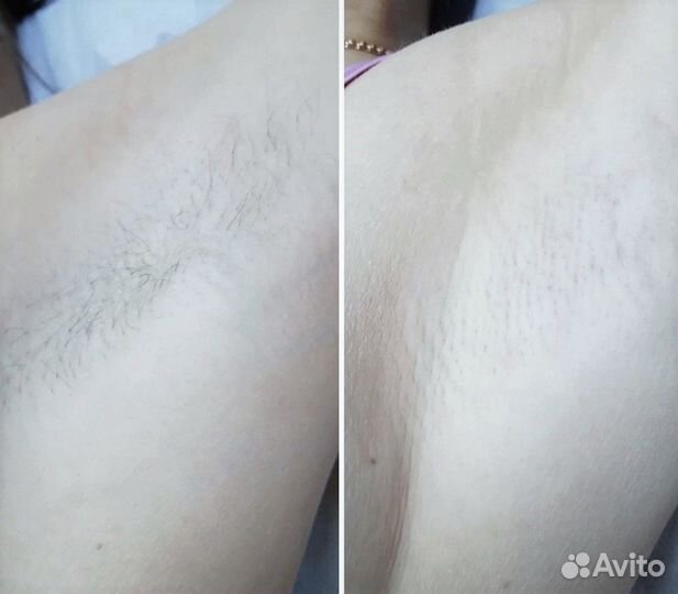 Лазерная эпиляция ищу модель