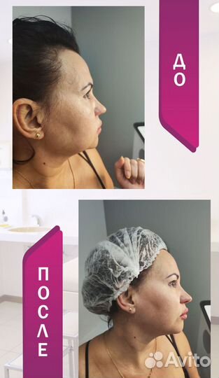 Убрать заломы, убрать морщины, лифтинг