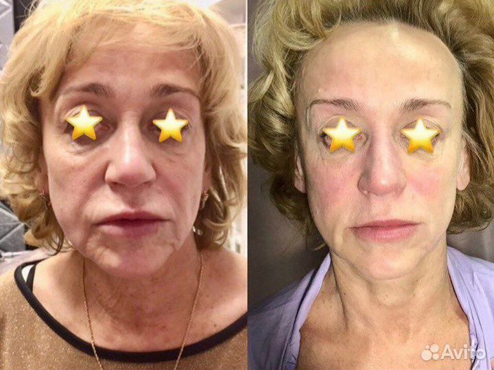 Массаж лица и головы миофасциальный