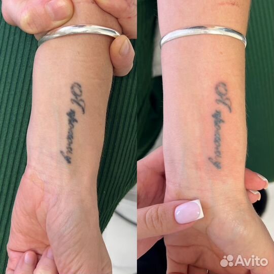 Лазерное удаление татуажа тату бесплатно