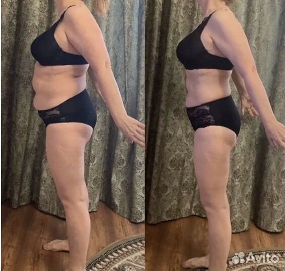 Жиротоп Кавитация, RF лифтинг